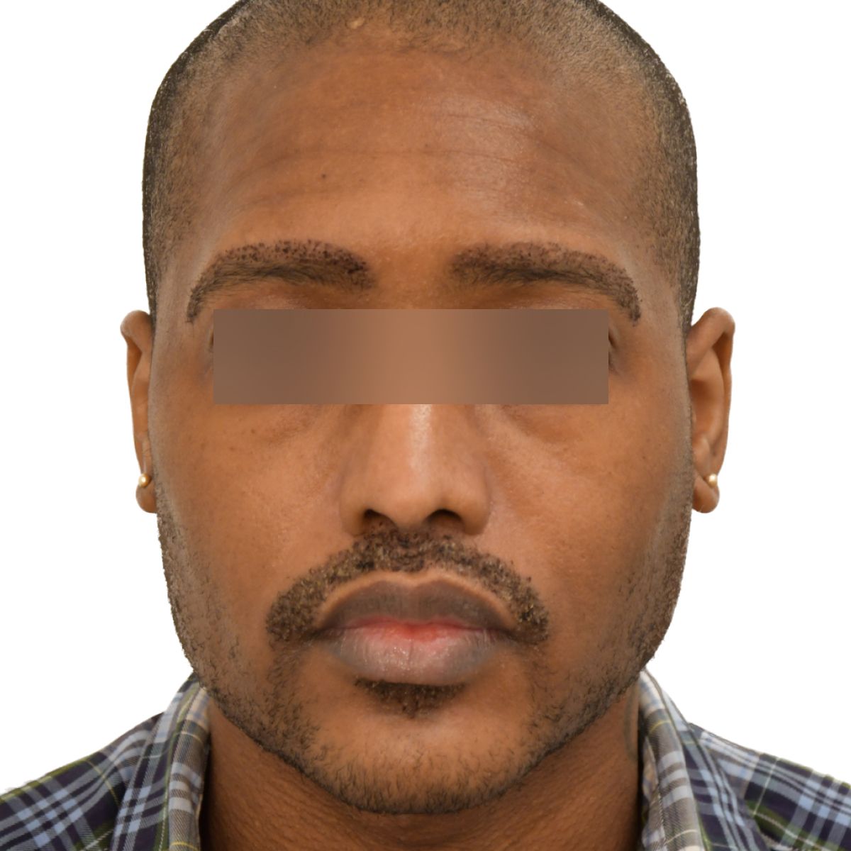 gender affirming hair transplant after