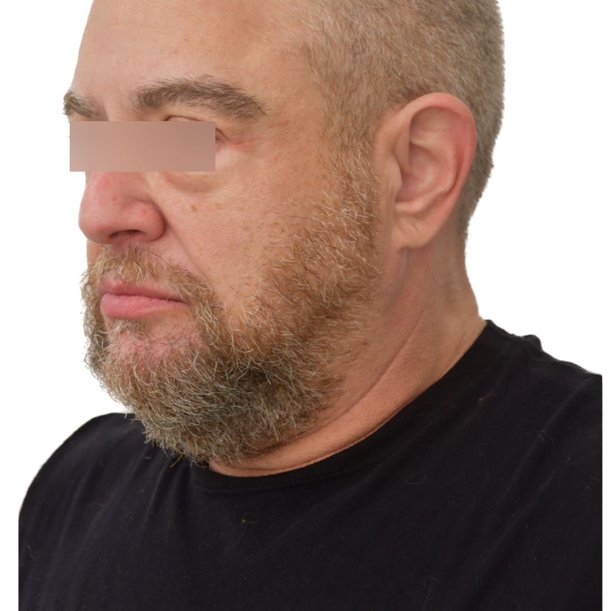 gender affirming hair transplant after