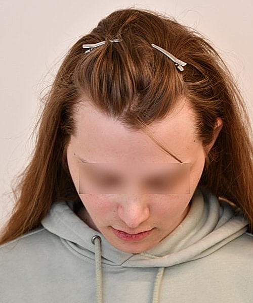 Person with hair clips, looking down.
