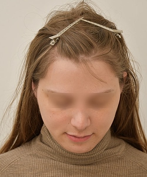 Person with hair clips looking downwards.