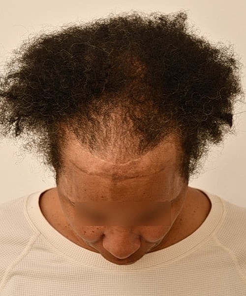 Person with uneven, thinning curly hair.