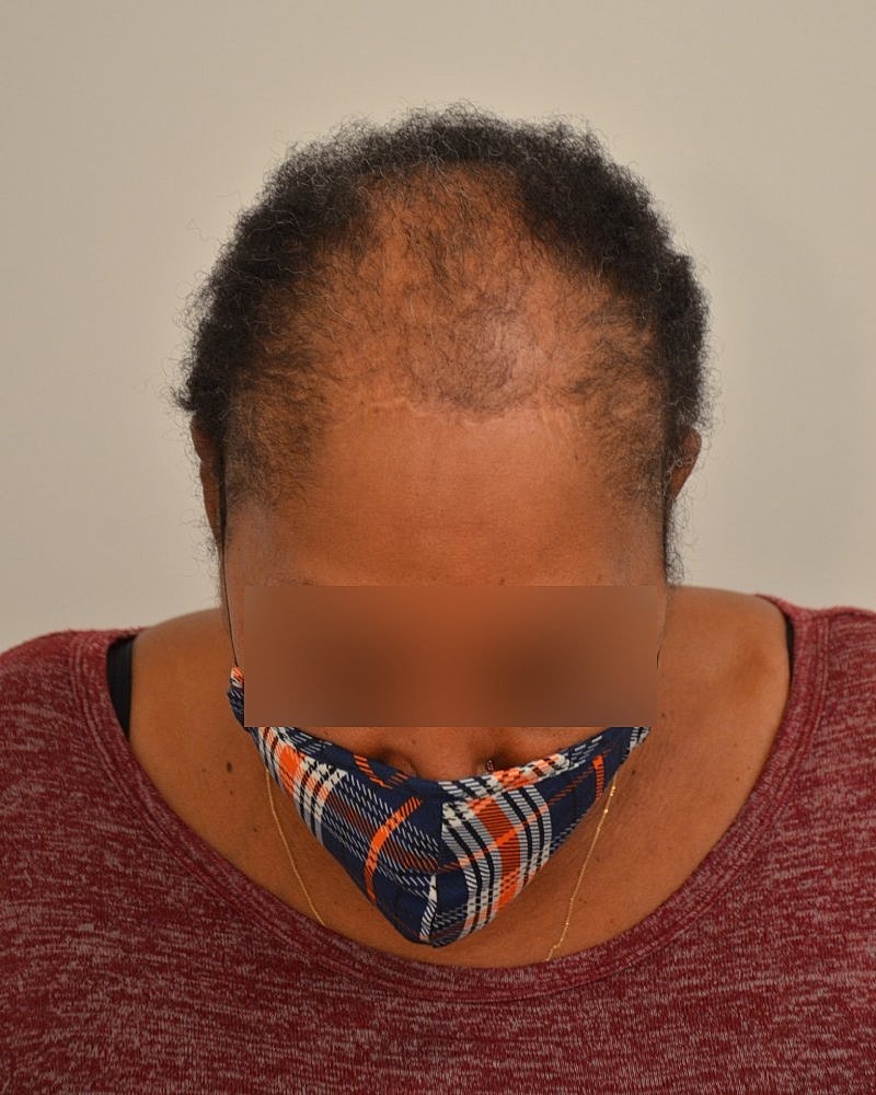 Gender-Affirming Hair Transplant (MTF) Before & After