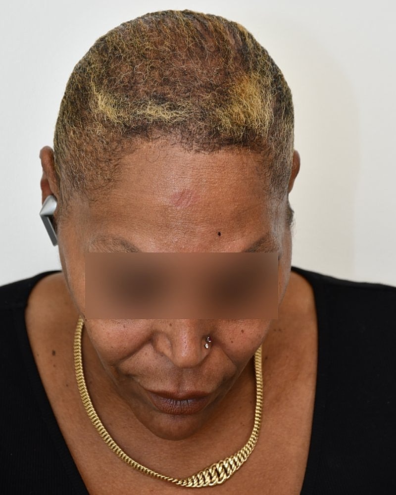 Gender-Affirming Hair Transplant (MTF) Before & After