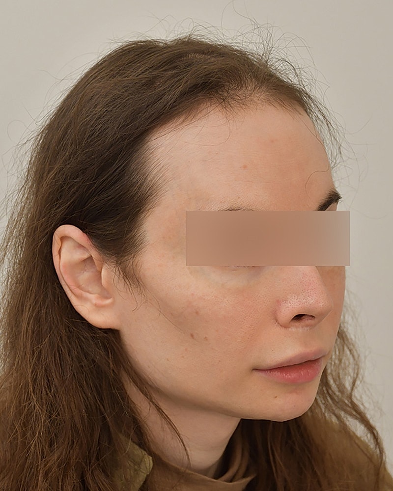 Gender-Affirming Hair Transplant (MTF) Before & After