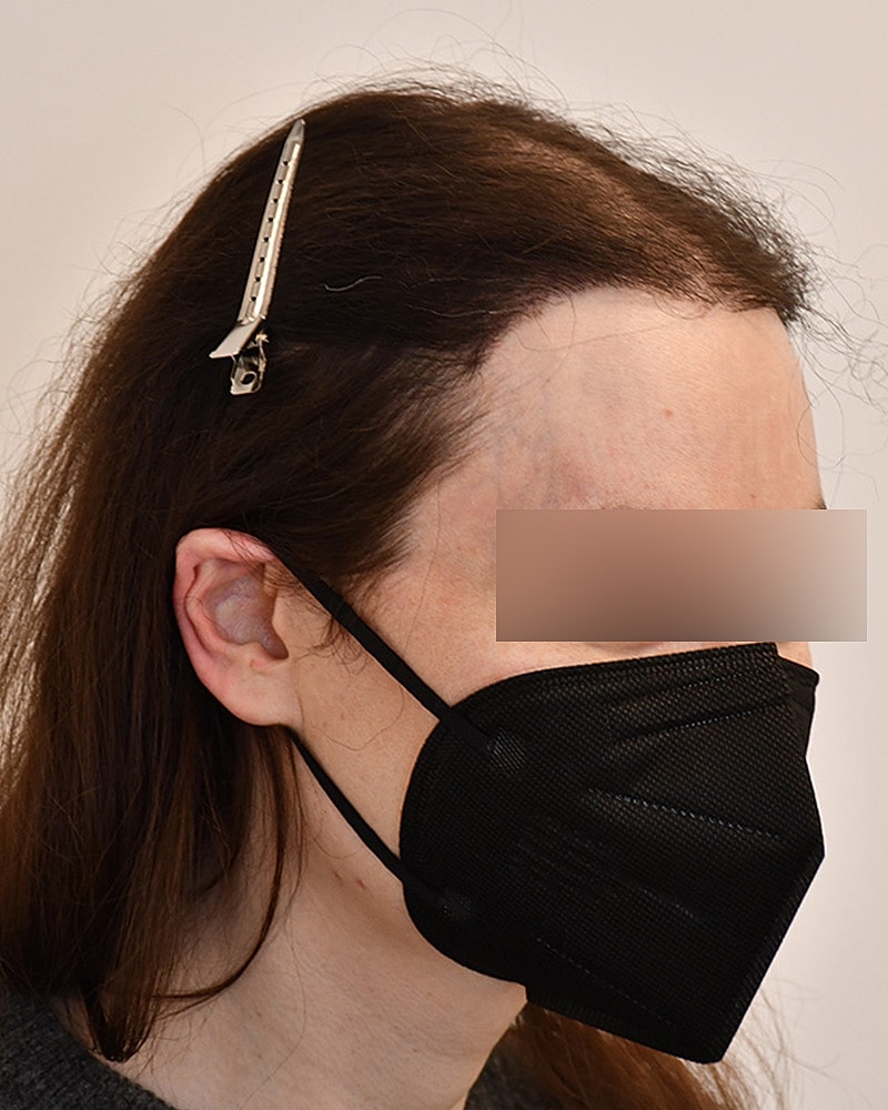 Gender-Affirming Hair Transplant (MTF) Before & After