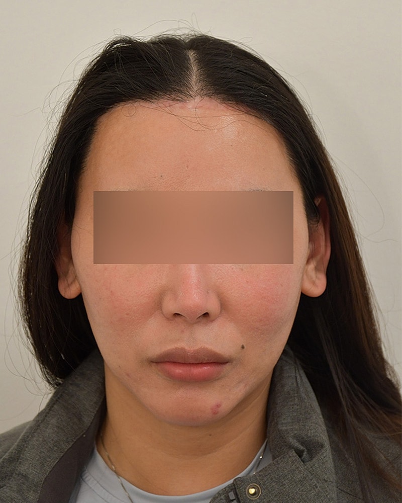 Gender-Affirming Hair Transplant (MTF) Before & After