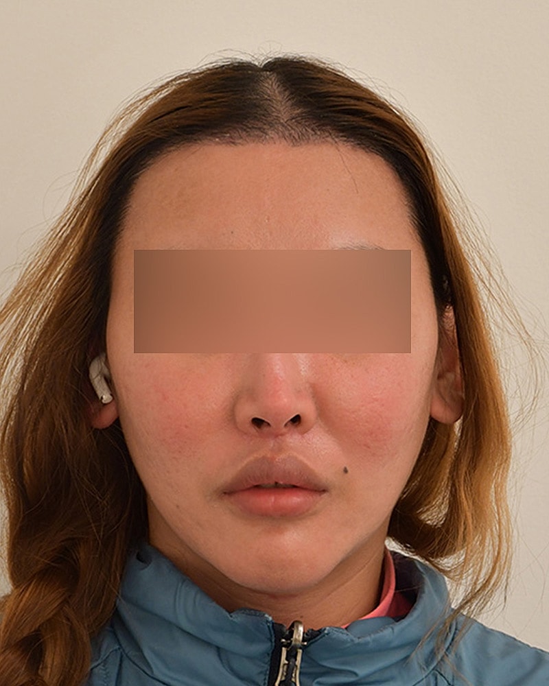 Gender-Affirming Hair Transplant (MTF) Before & After