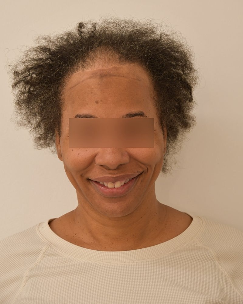 Gender-Affirming Hair Transplant (MTF) Before & After