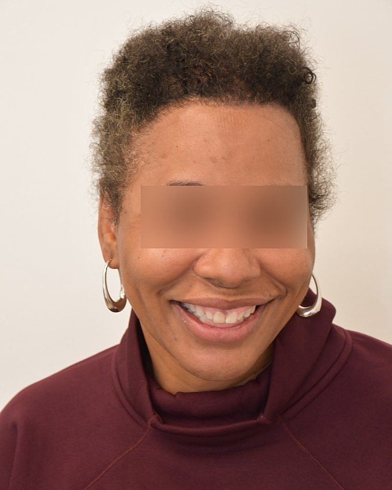 Gender-Affirming Hair Transplant (MTF) Before & After