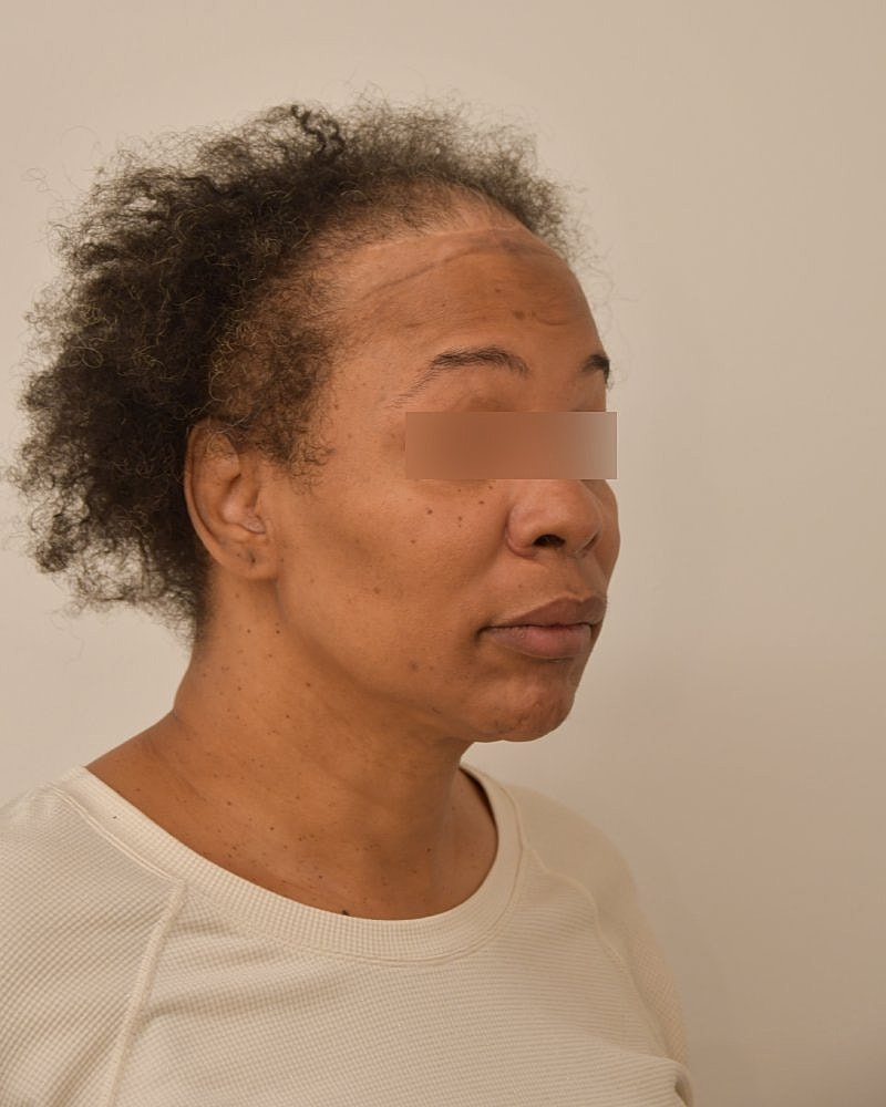 Gender-Affirming Hair Transplant (MTF) Before & After