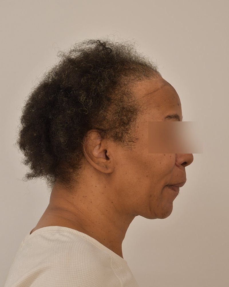 Gender-Affirming Hair Transplant (MTF) Before & After