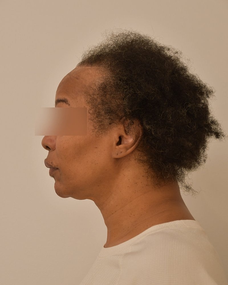 Gender-Affirming Hair Transplant (MTF) Before & After