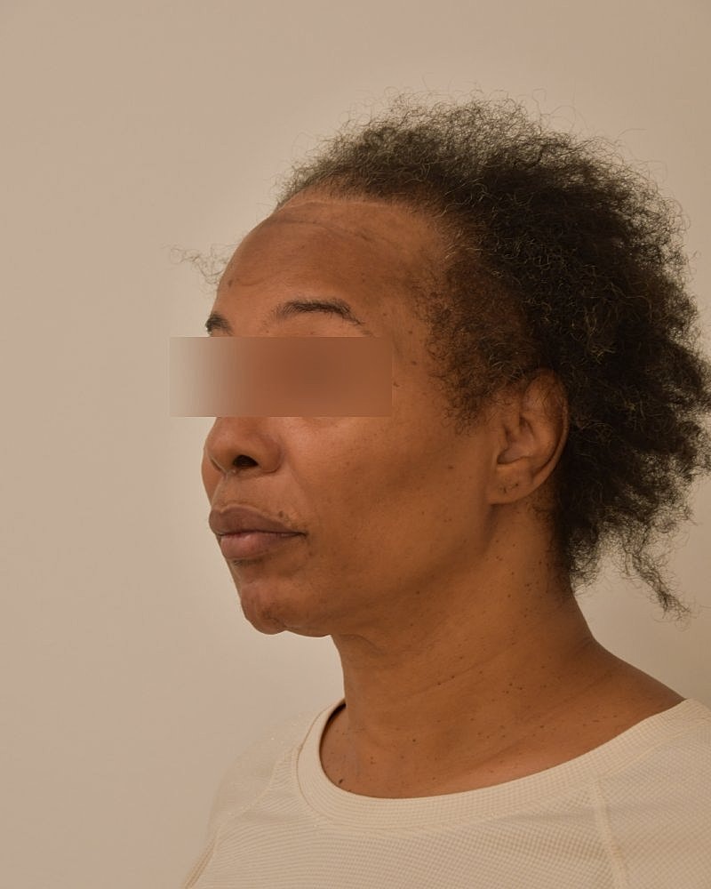 Gender-Affirming Hair Transplant (MTF) Before & After