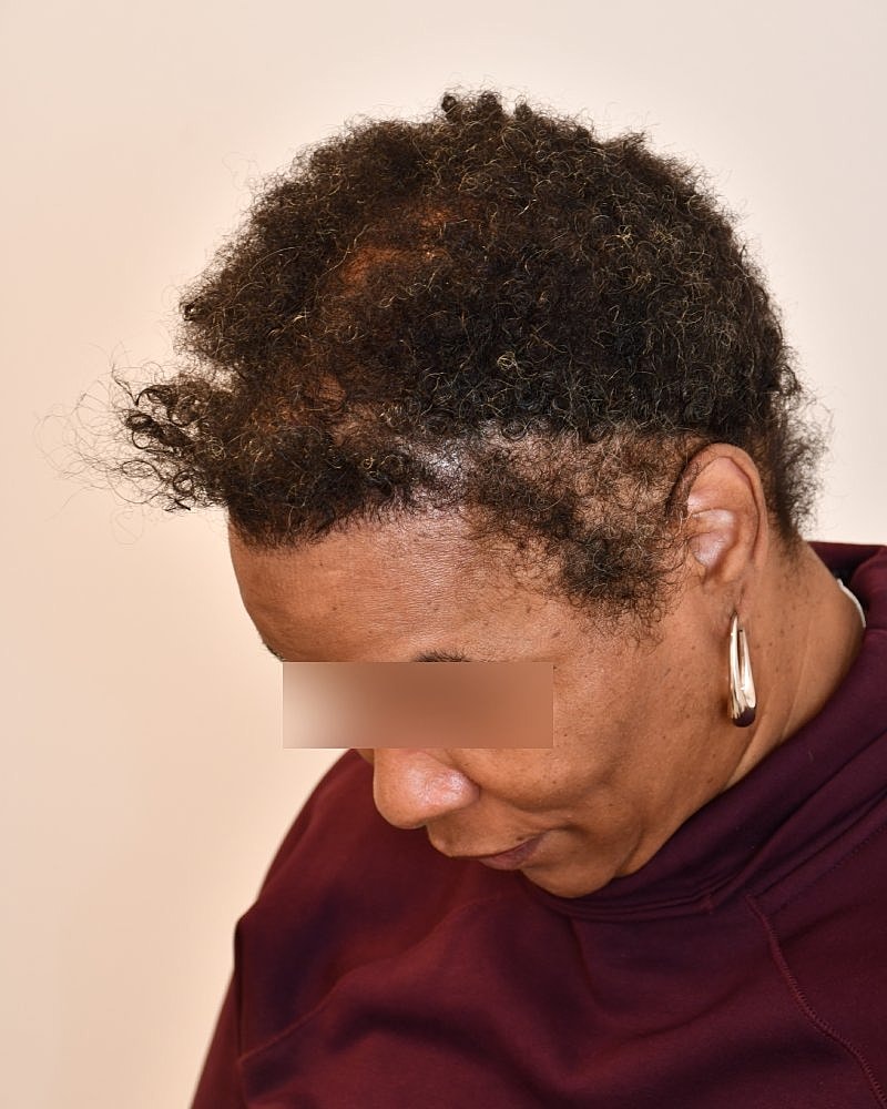 Gender-Affirming Hair Transplant (MTF) Before & After