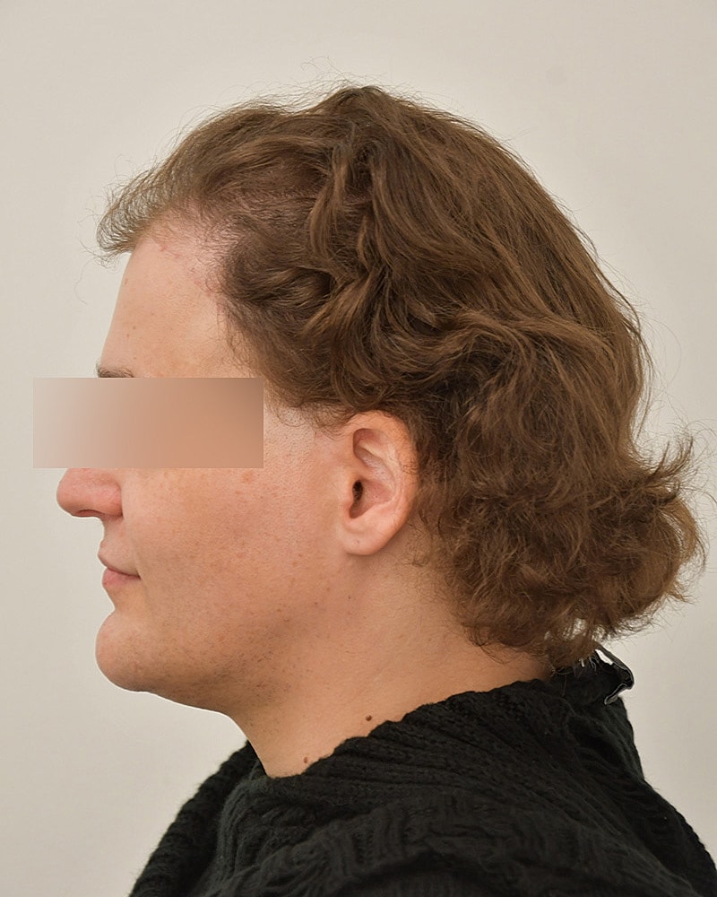 Gender-Affirming Hair Transplant (MTF) Before & After