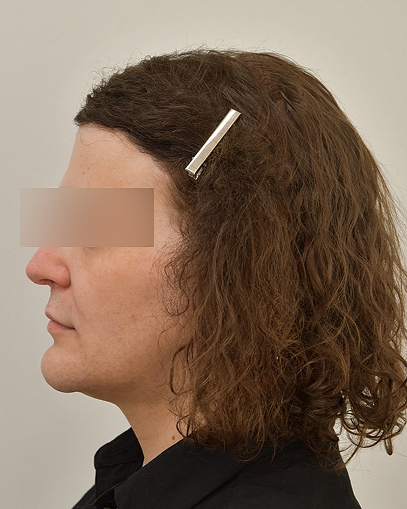 Gender-Affirming Hair Transplant (MTF) Before & After