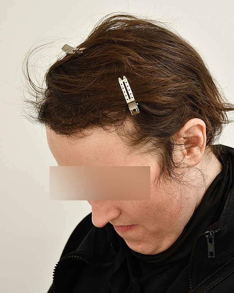 Gender-Affirming Hair Transplant (MTF) Before & After