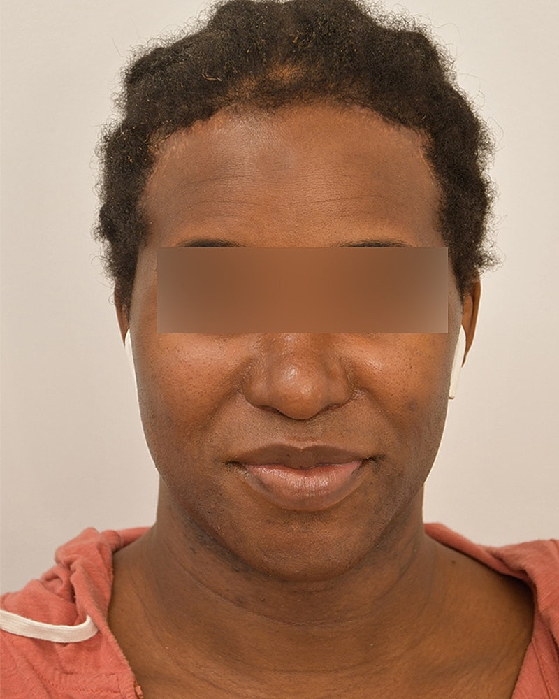 Gender-Affirming Hair Transplant (MTF) Before & After