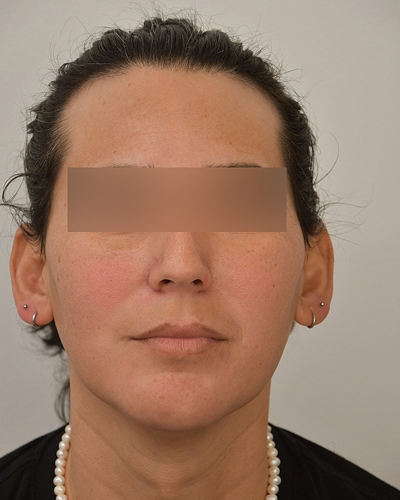 Gender-Affirming Hair Transplant (MTF) Before & After