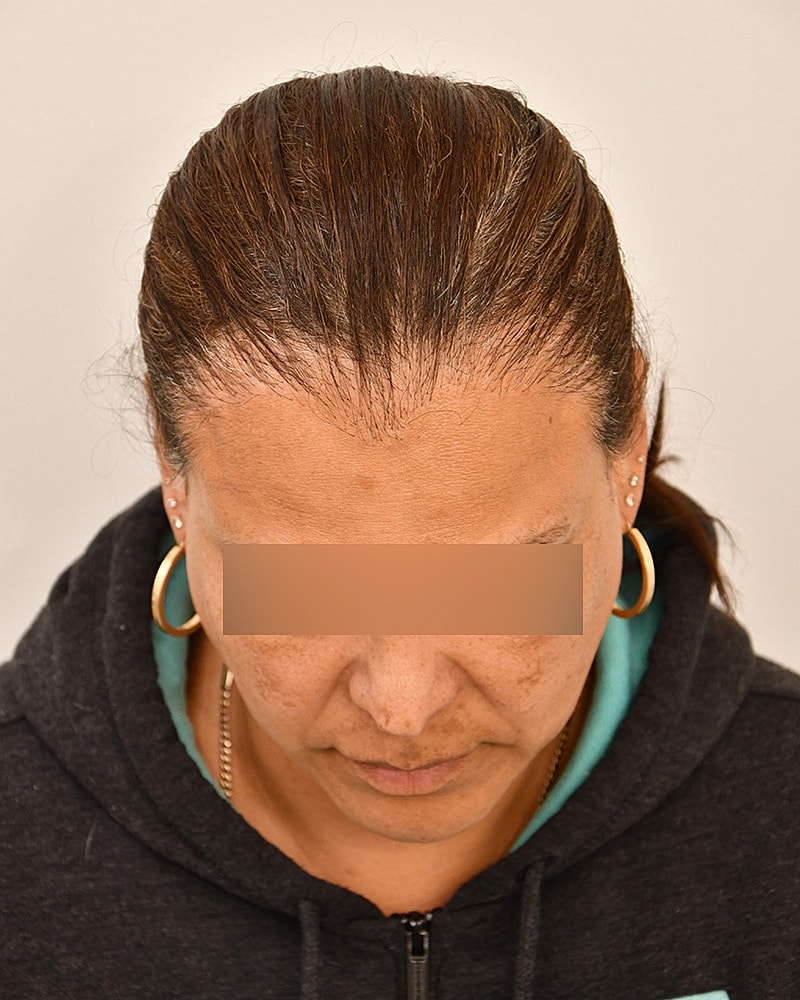 Gender-Affirming Hair Transplant (MTF) Before & After