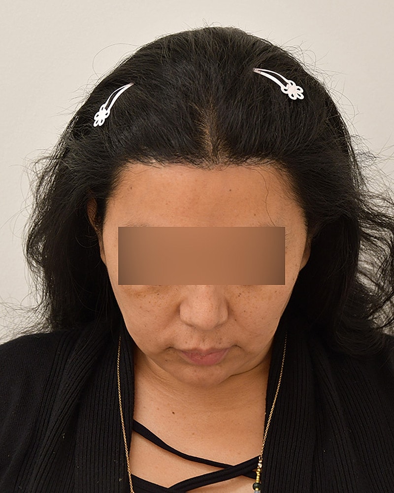 Gender-Affirming Hair Transplant (MTF) Before & After