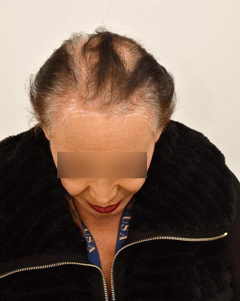 Gender-Affirming Hair Transplant (MTF) Before & After