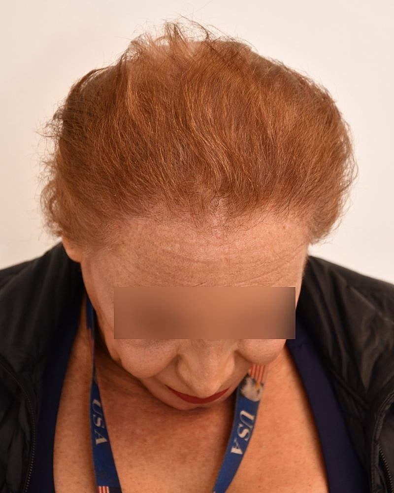 Gender-Affirming Hair Transplant (MTF) Before & After