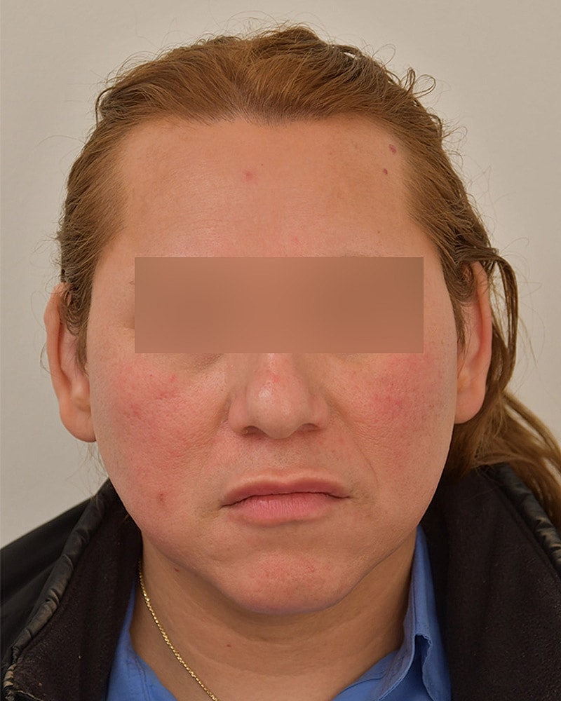 Gender-Affirming Hair Transplant (MTF) Before & After