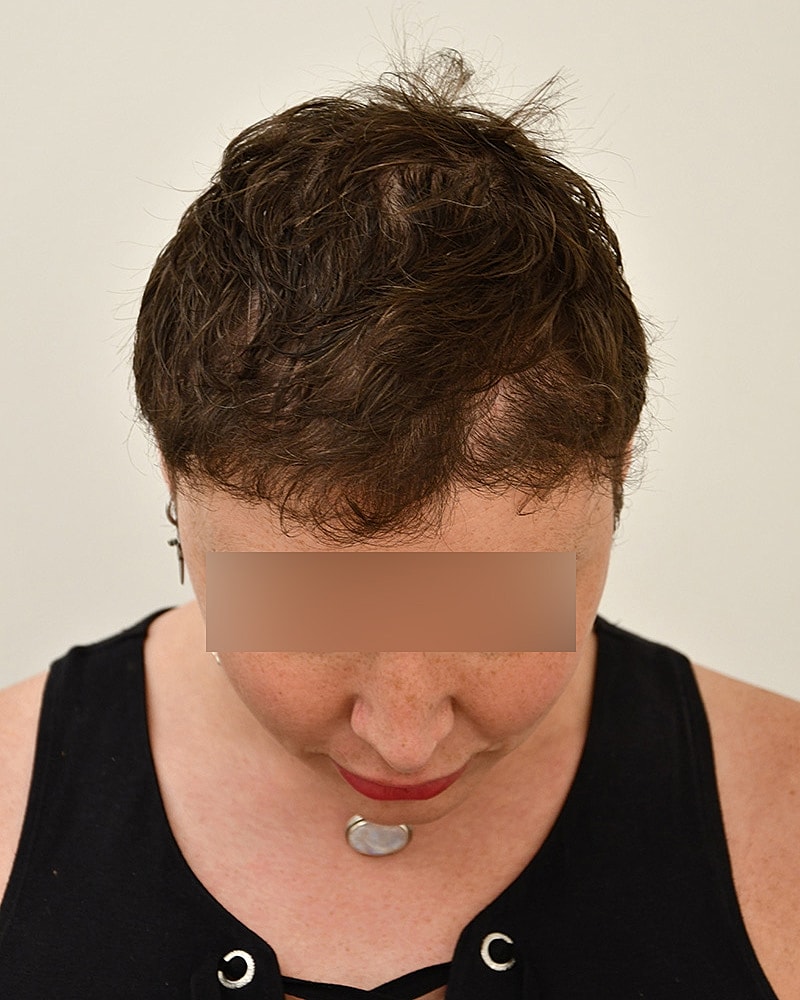 Gender-Affirming Hair Transplant (MTF) Before & After