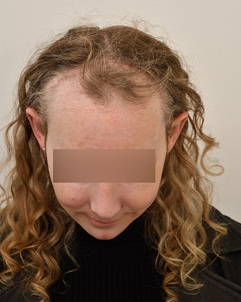 Gender-Affirming Hair Transplant (MTF) Before & After