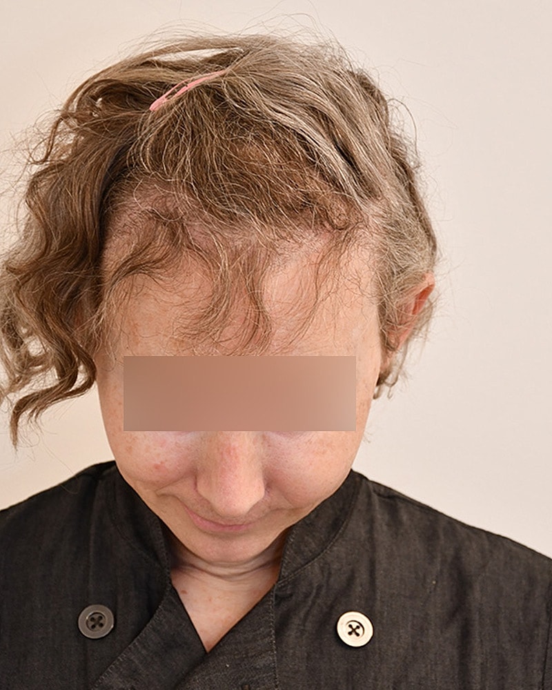 Gender-Affirming Hair Transplant (MTF) Before & After