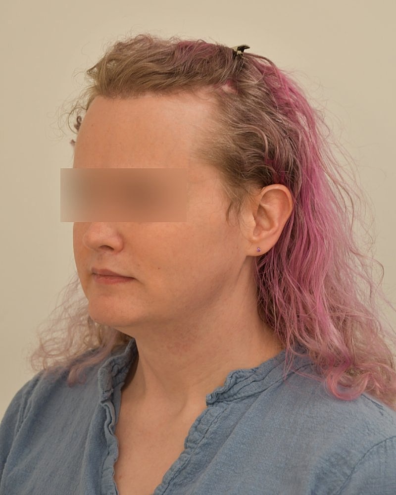 Gender-Affirming Hair Transplant (MTF) Before & After