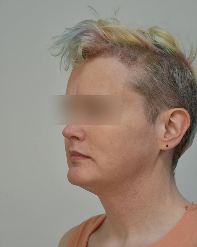 Gender-Affirming Hair Transplant (MTF) Before & After