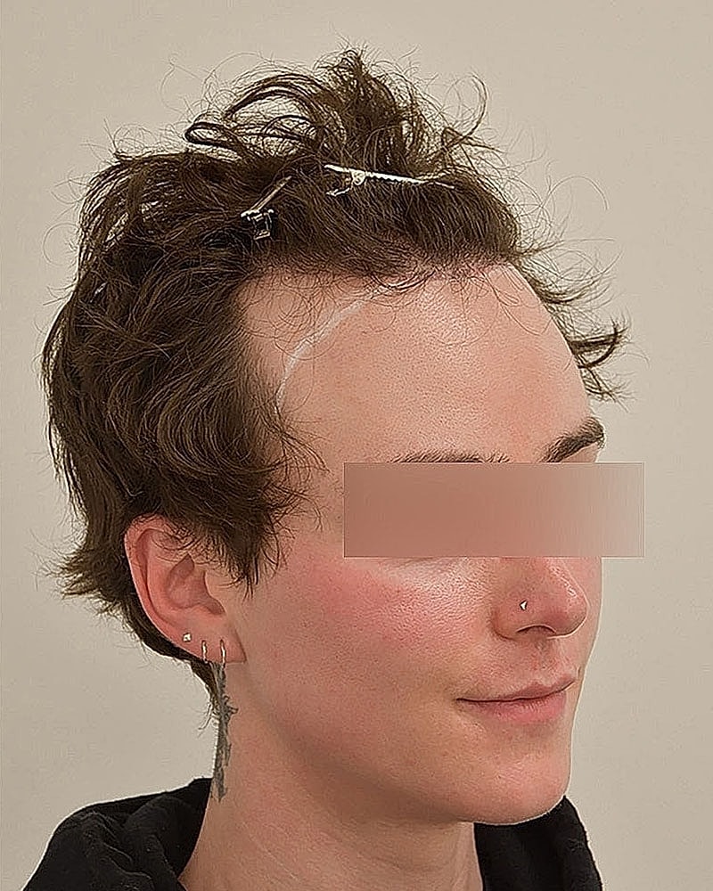 Gender-Affirming Hair Transplant (MTF) Before & After
