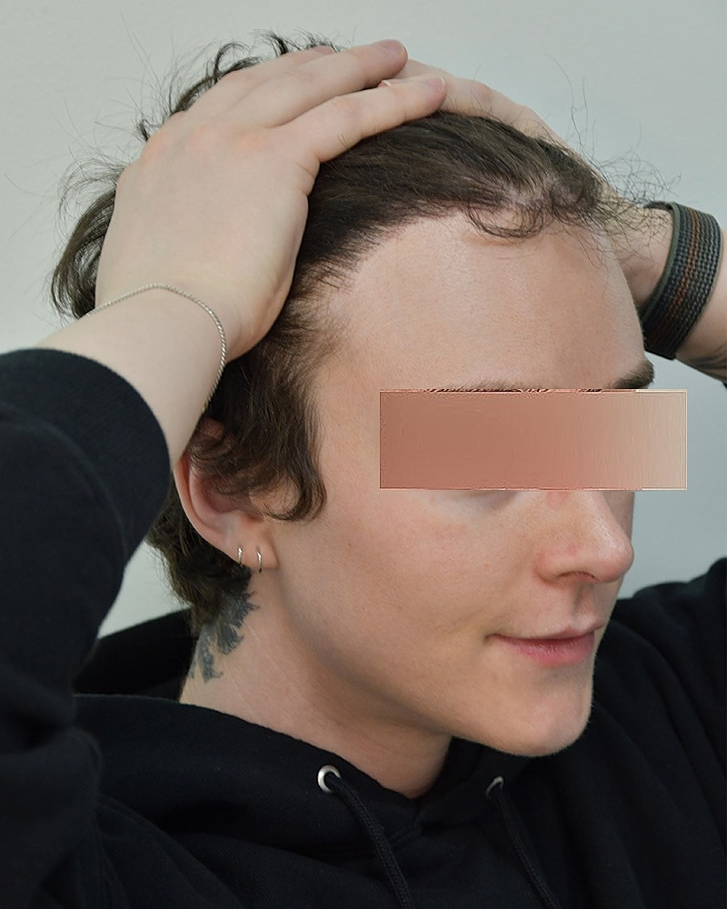 Gender-Affirming Hair Transplant (MTF) Before & After