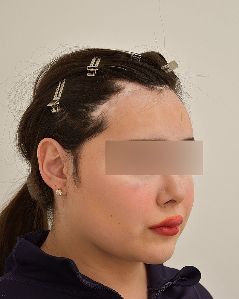 Gender-Affirming Hair Transplant (MTF) Before & After
