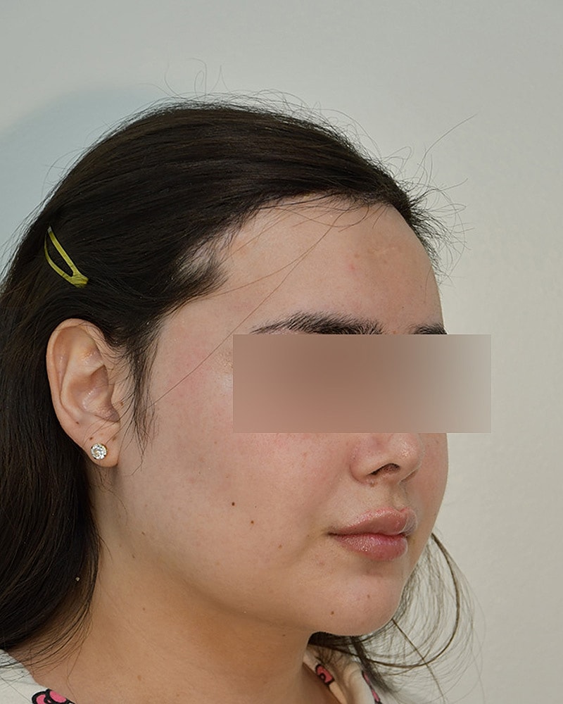 Gender-Affirming Hair Transplant (MTF) Before & After