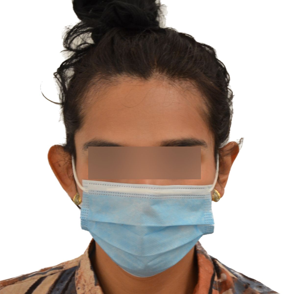 gender affirming hair transplant before