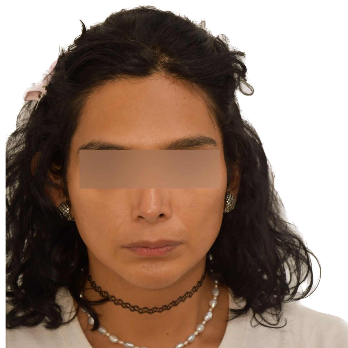 gender affirming hair transplant after