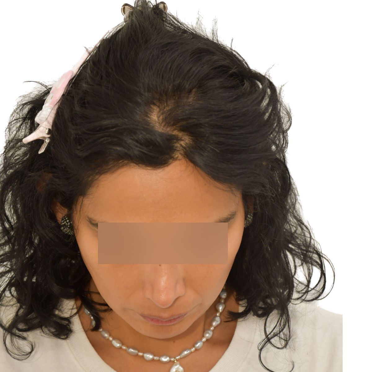 gender affirming hair transplant after