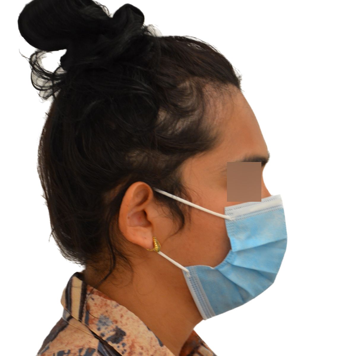 gender affirming hair transplant before