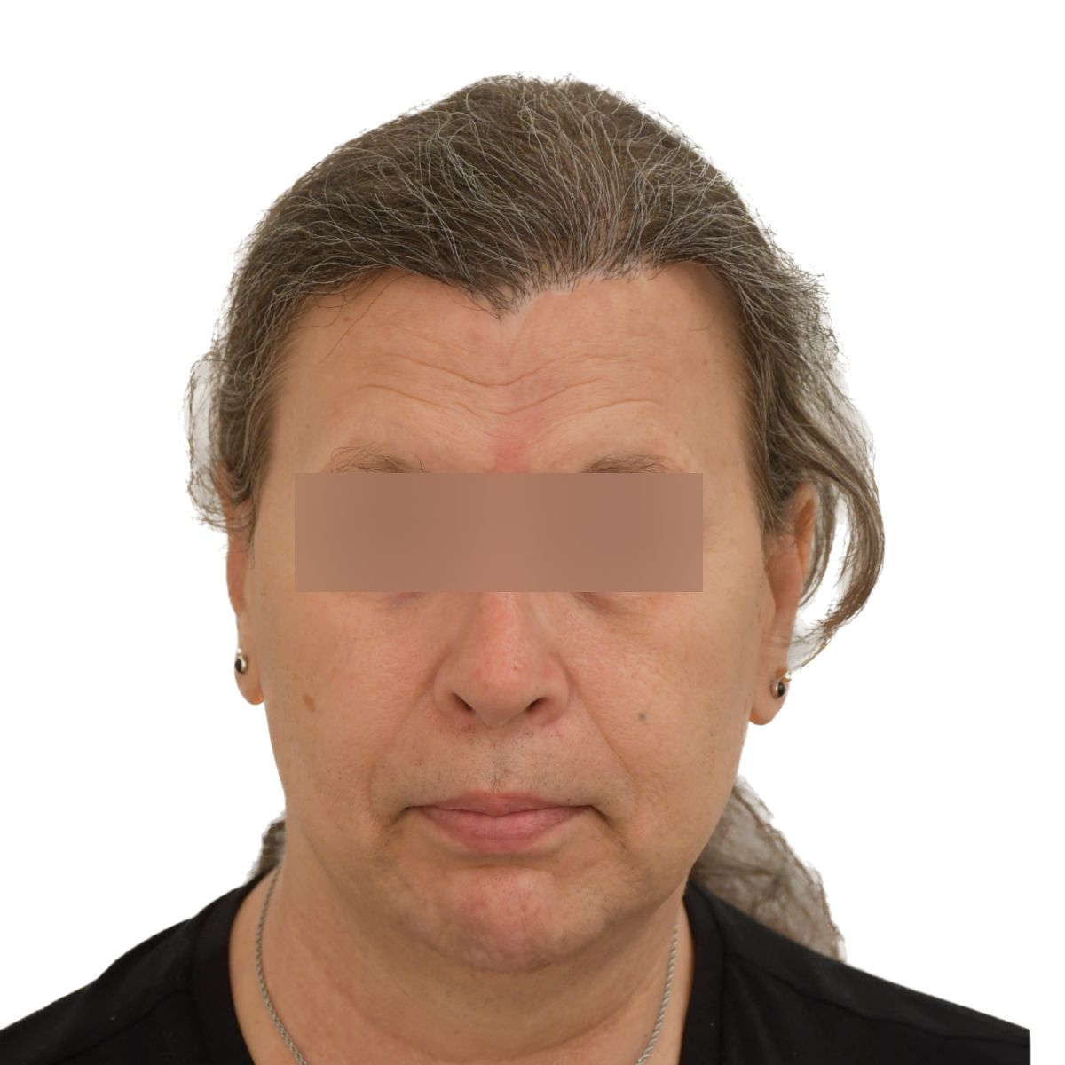 gender affirming hair transplant after