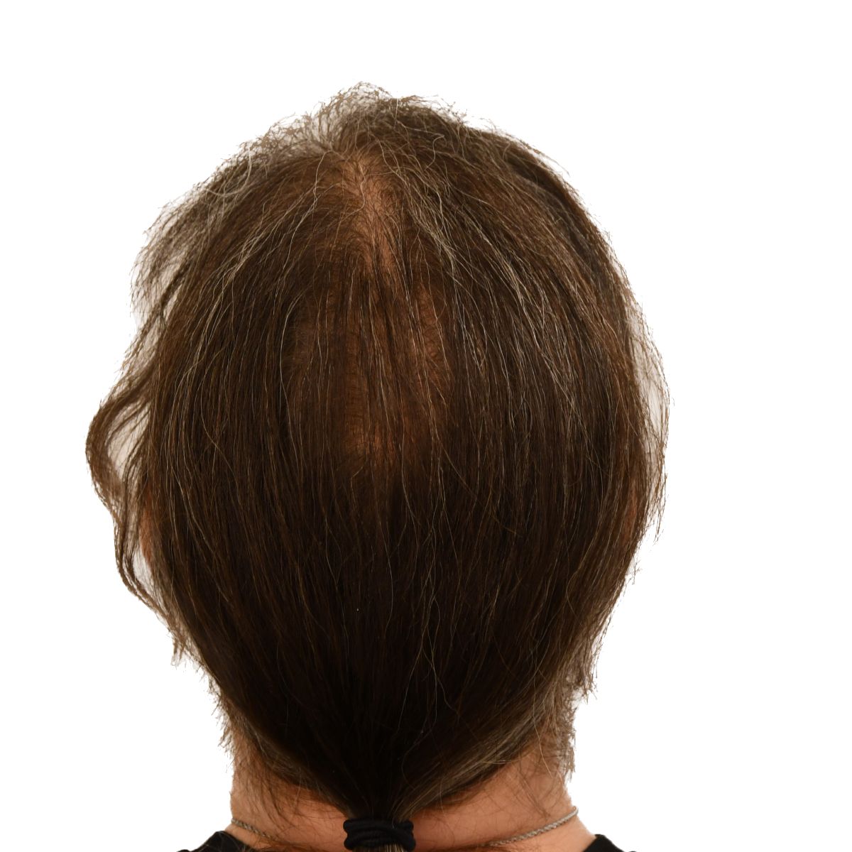 gender affirming hair transplant after