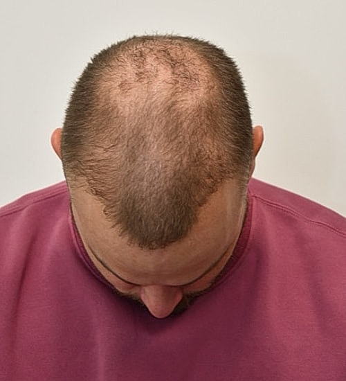 Man with thinning hair looking downwards.