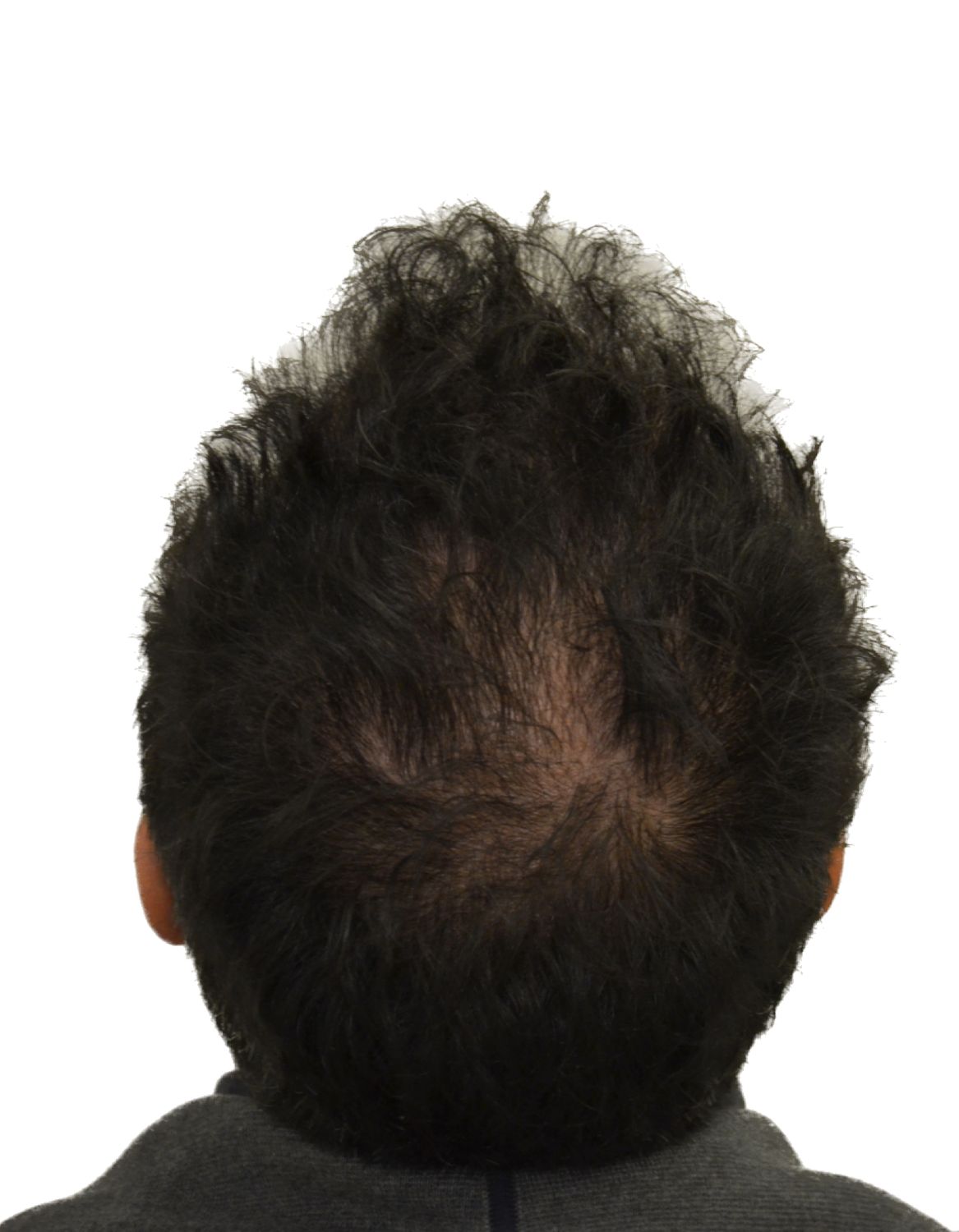 hair transplant before