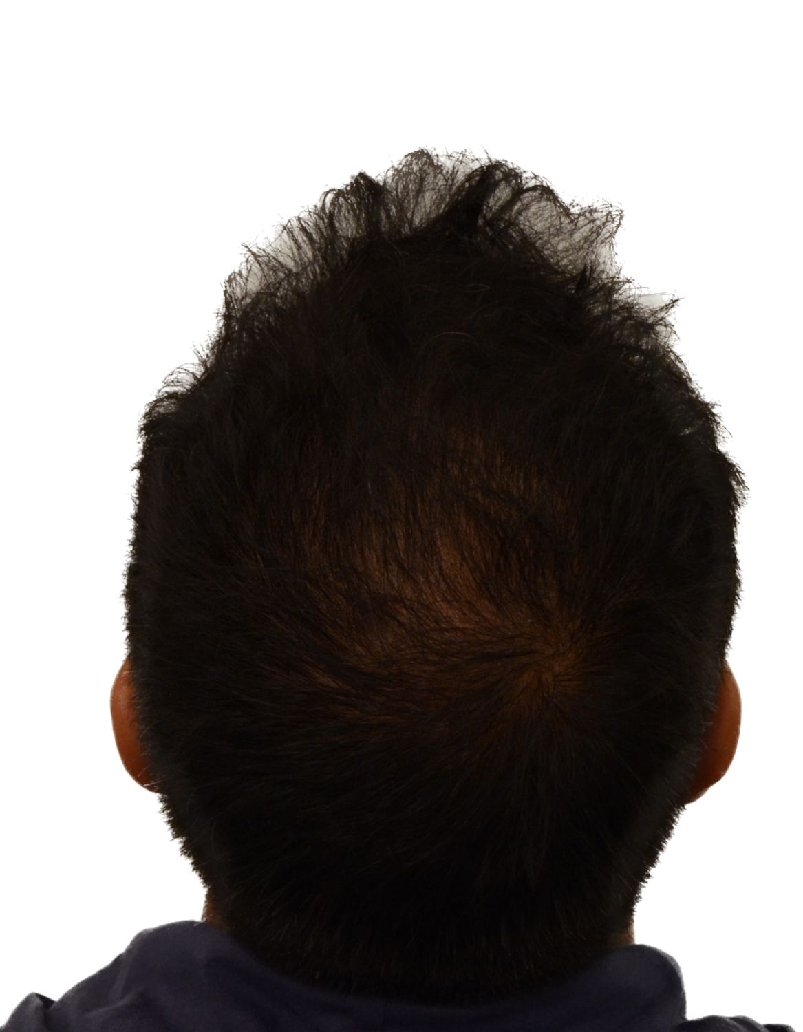 hair transplant after