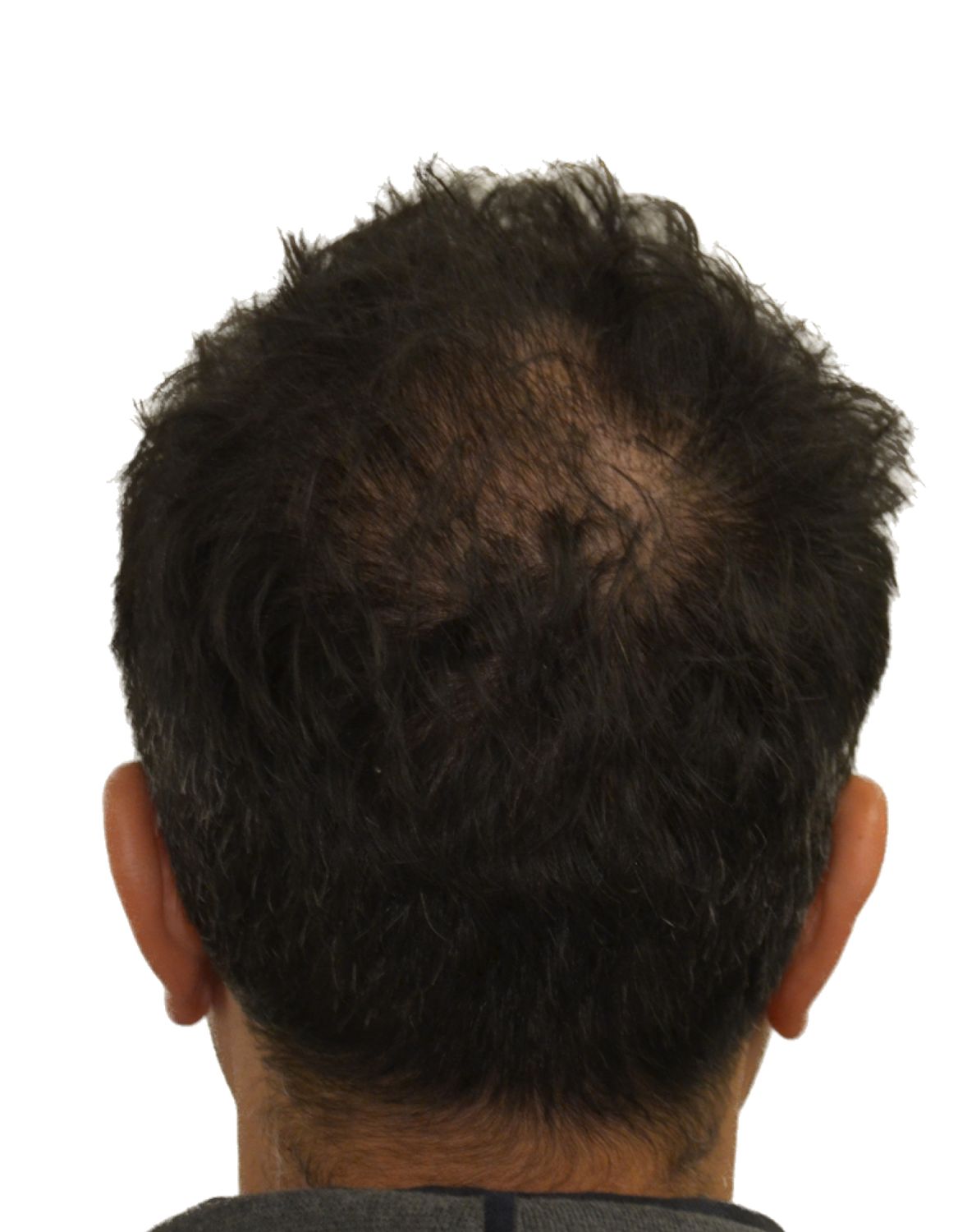 hair transplant before