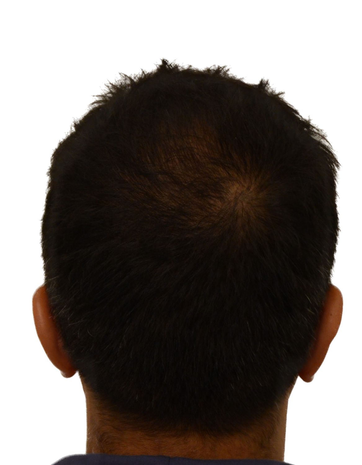 hair transplant after