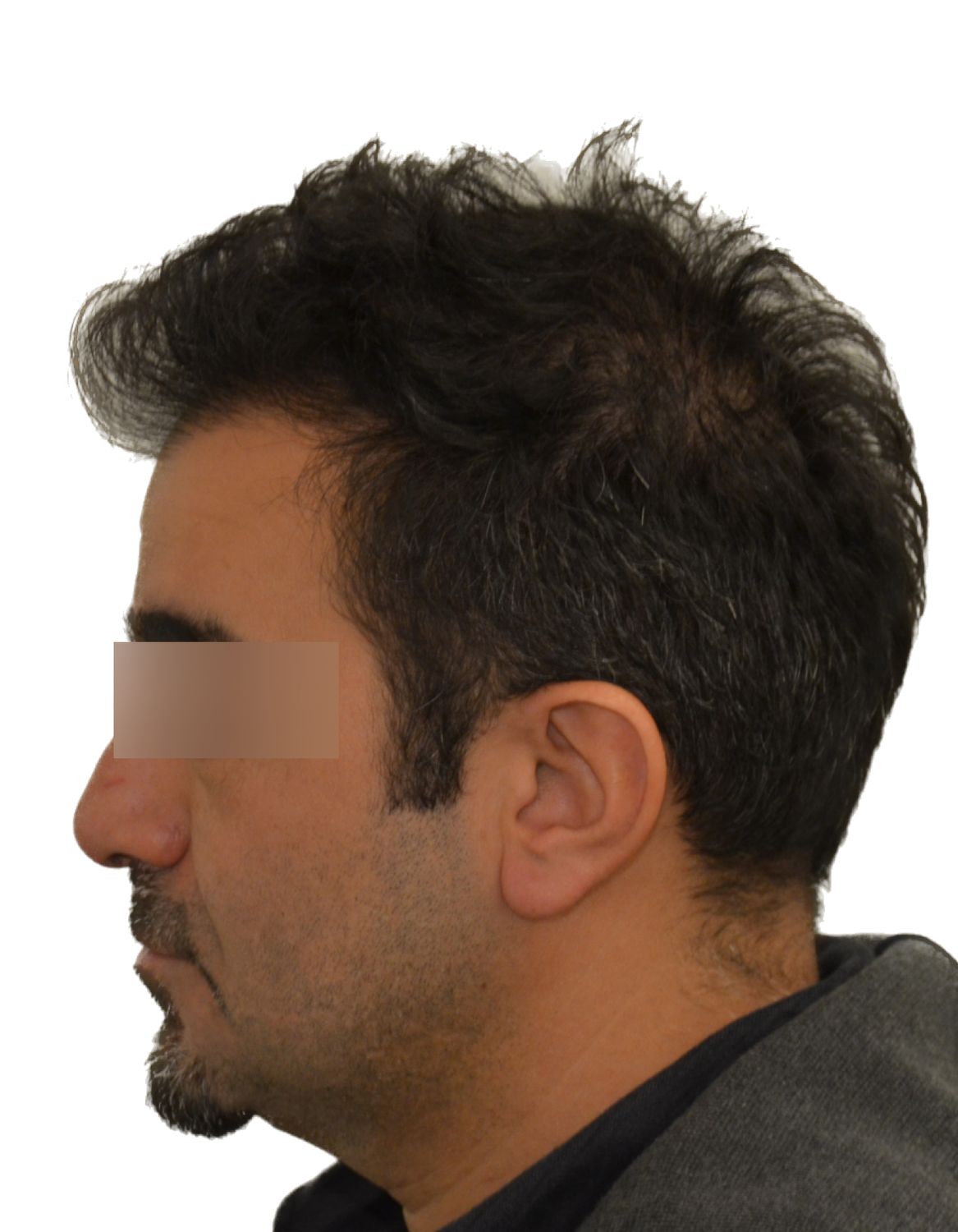 hair transplant before
