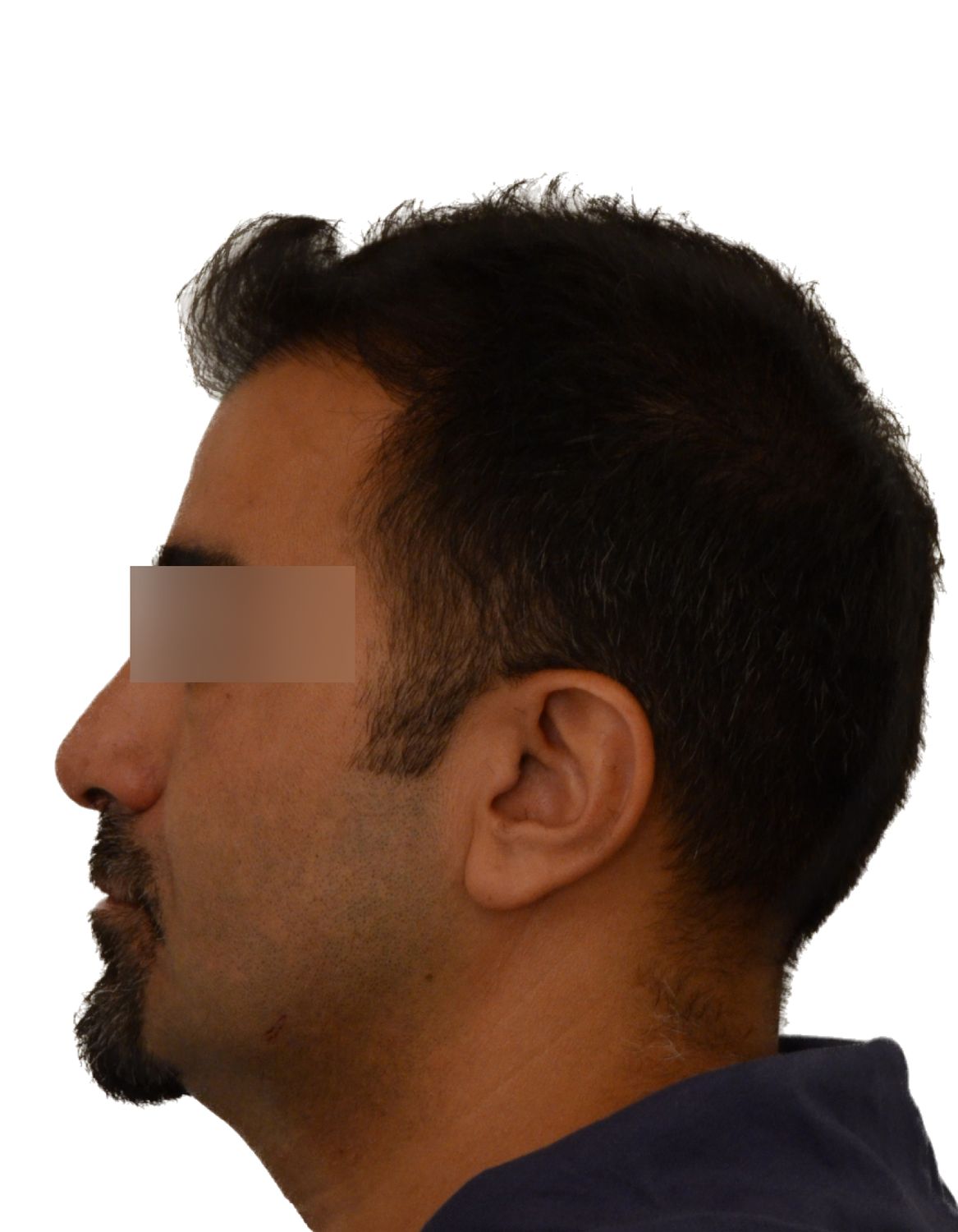 hair transplant after